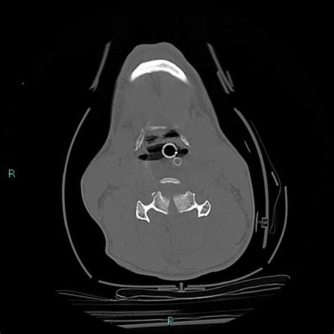 Cervical Vertebral Burst Fracture Radiology Case