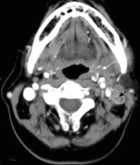 Axial View Of The Neck Ct With Enhancement Revealed Multiple Pathologic