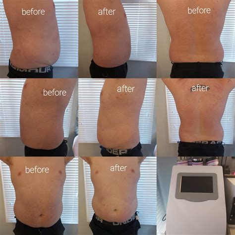 Aqualyx Fat Dissolving Treatment With Stephanie At Beautyful Drawn 24