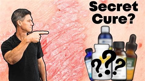 Psoriasis Relief Naturally: Discover the Top 5 Supplements - YouTube