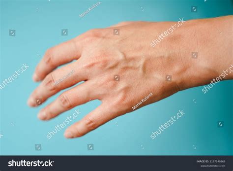 Protruding Veins On Female Hands Closeup Stock Photo 2197140369