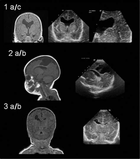 Cranial Ultrasound And Mri At Term Age In Extremely Preterm Infants