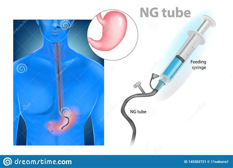Nasogastric Tube. The Liquid Feeding By Insert NG Tube Passes Th ...
