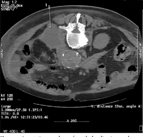 figure 4 from ct guided intra abdominal abscess drainage semantic free download nude photo gallery