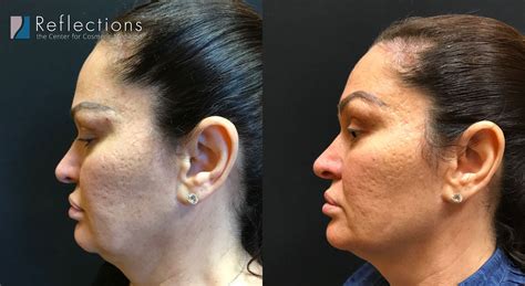 Kybella For Jowls Injections Before After Photos New Jersey