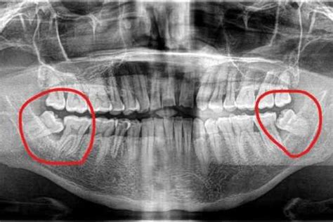 Affordable Impacted Wisdom Tooth Removal Houston Keemsmile