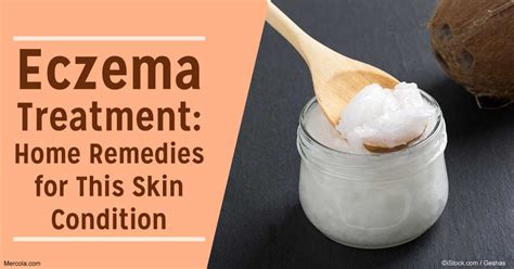 How To Treat Eczema