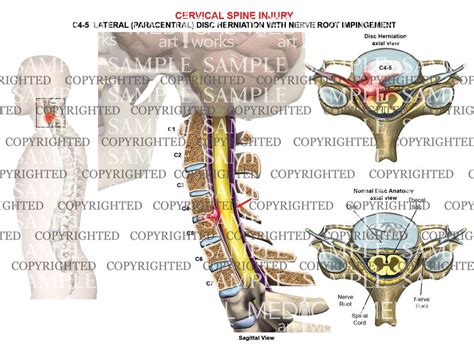 C4 5 Disc Herniation Nerve Root Impingement Medical Art Works