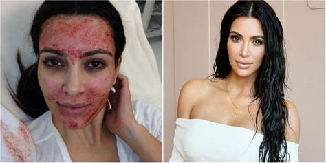 Kim Kardashian Before And After Plastic Surgery Celebrity