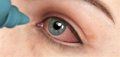 7 Reasons For Eye Infections Marham