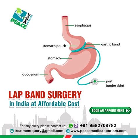 Best Lap Band Surgery At Affordable Cost Lap Band Surgery Lap Band