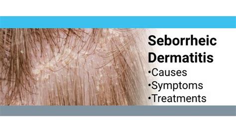 How To Treat Seborrheic Dermatitis Dandruff Deconstructed