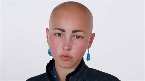Watch What Makes This Woman With Alopecia Feel Beautiful Dispelling