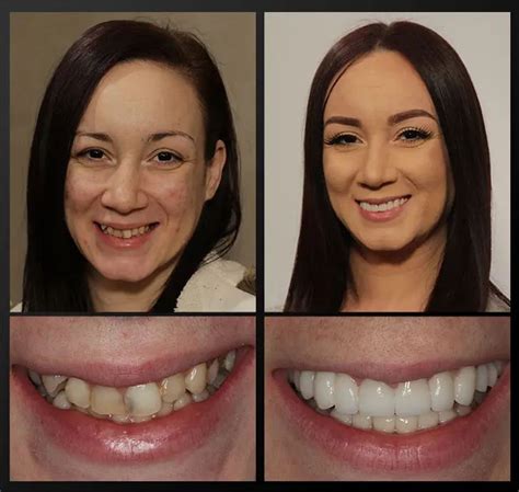 Smile Gallery Rochester Advanced Dentistry In 2020 Dentistry Smile Makeover Dental Makeover
