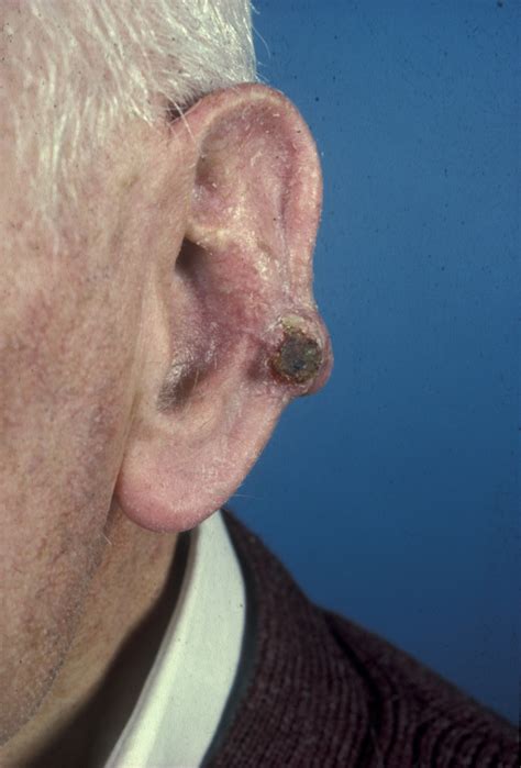 Skin Cancer Lesions On Face