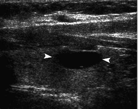 Thyroid Nodules Causes Symptoms Ultrasound Surgery