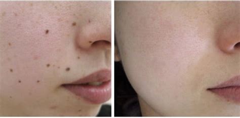 Mole Removal Before And After Turkey Mole Removal