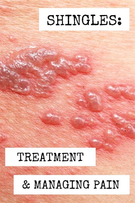 Shingles Treatment And Managing Pain Wcei Blog Wcei Blog