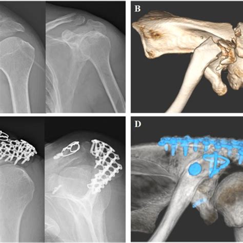 A Left Acromion Fracture And Ipsilateral Distal Clavicle Fracture On