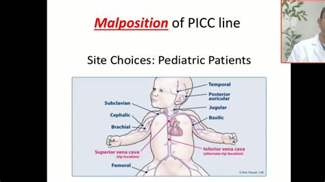 Case 30 Picc Line Malposition In Left Atrium Approach For Insertion