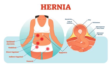 Hiatal Hernia In Women