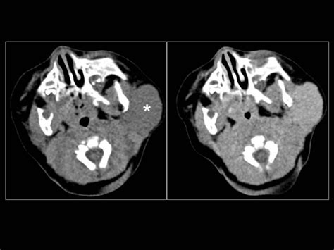 Parotid Hemangioma Ct Without Contrast Right And Contrasted Ct
