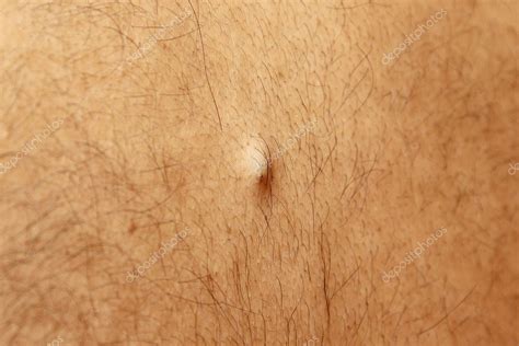 Sebaceous Epidermoid Cyst On The Back Of The Male — Stock Photo