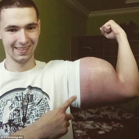 Russian Popeye Flexes His Chemical Injected Biceps Daily Mail Online