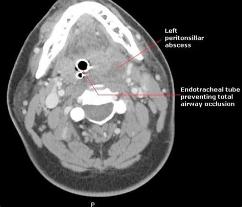 Peritonsillar Abscess Concise Medical Knowledge Hot Sex Picture