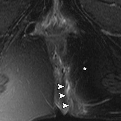 Rectal Imaging Part 2 Perianal Fistula Evaluation On Pelvic MRI