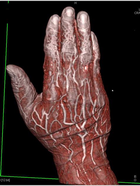 Cellulitis In The Hand With Vascular Mapping Musculoskeletal Case