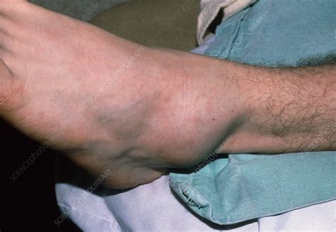 Swollen Left Ankle Due To Sprain Stock Image M3300737 Science
