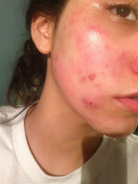 Skin Concern Am I Having An Allergic Reaction Skincareaddiction