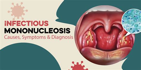 Infectious Mononucleosis Causes Symptoms Diagnosis