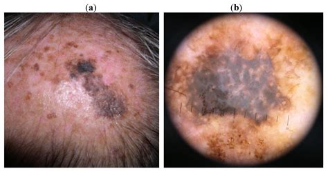 Cancers Free Full Text Dermoscopy Of Scalp Melanoma Report Of
