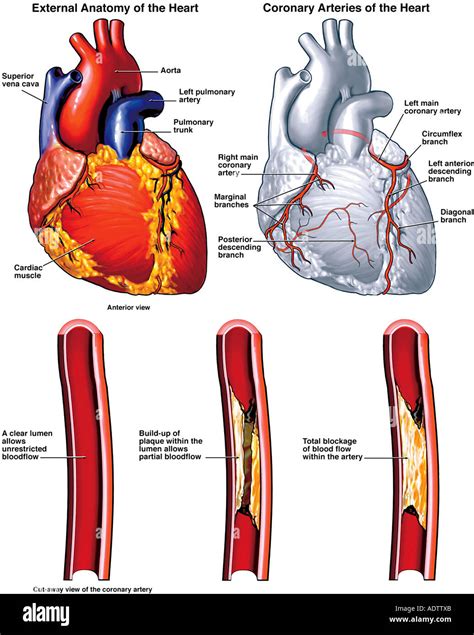 Anatomía Del Corazón Con Posibles Sitios De Obstrucción De Las Arterias