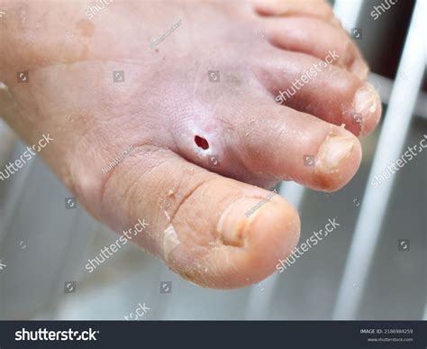 Wound Infection Diabetes Cellulitis Foot Skinmedical Stock Photo