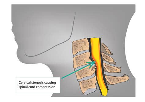 Estenosis cervical Cómo tratarla Instituto Cirugía de Columna