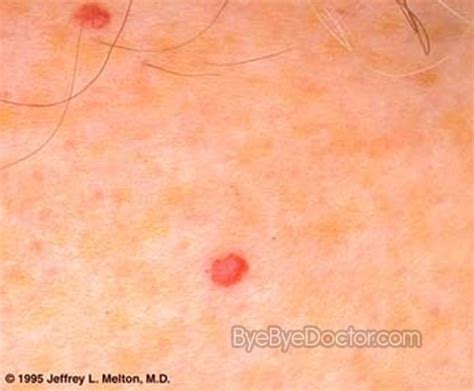 Cherry Angioma Pictures Causes Removal Treatment Symptoms Causes Treatment And Prevention
