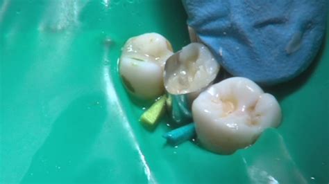 Operatoria Dental Y Endodoncia12 Composite Grandes Reconstrucciones