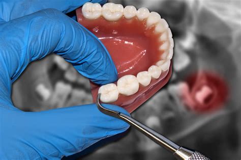 How should i sleep after my wisdom teeth are taken out? Wisdom Teeth Removal | Extraction | Oral Surgeon ...