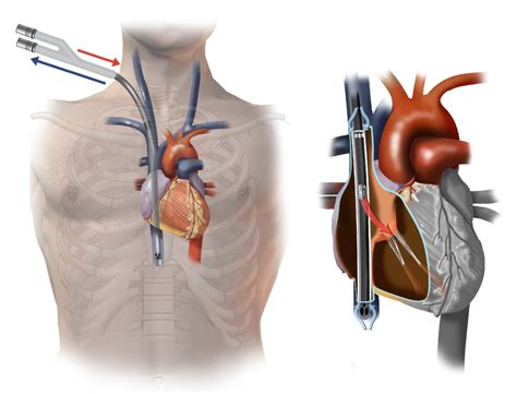 An overview choosing the appropriate configuration and cannulation strategies for extracorporeal membrane. ECMO - LearnPICU