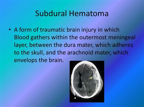 Ppt Epiduralsubdural Hematoma Powerpoint Presentation Free Download