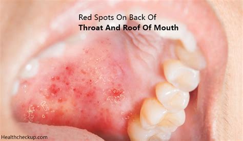 Major causes of bump on roof of mouth. Red Spots on Back of Throat and Roof of Mouth - Causes ...