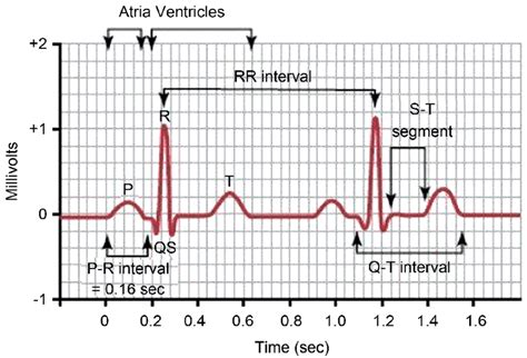 Normal Electrocardiogram Tracing Waves Intervals And Segments