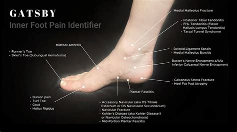 Foot Pain Chart An In Depth Guide To Identifying Foot Pain Gatsbyshoes
