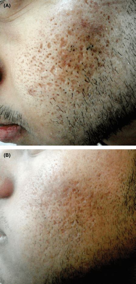 Group A Prp Injection A Male Patient With Grade 4 Acne Scars A