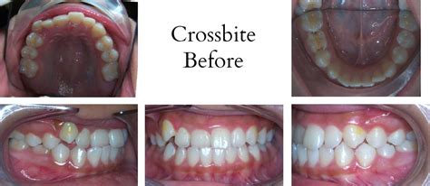 How To Fix A Crossbite And Underbite Braces Before And After