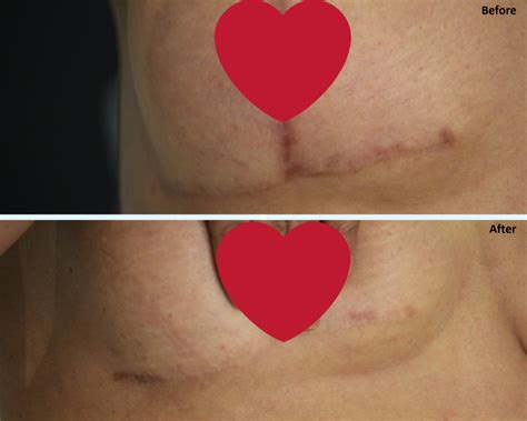 Treating Scars After Breast Surgery Géniale