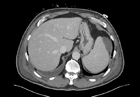 Triple Phase Ct Scan Of The Liver No Focal Lesions Were Present In The